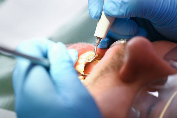 Best Emergency Dental Care for Broken or Chipped Teeth in Ferrum, VA