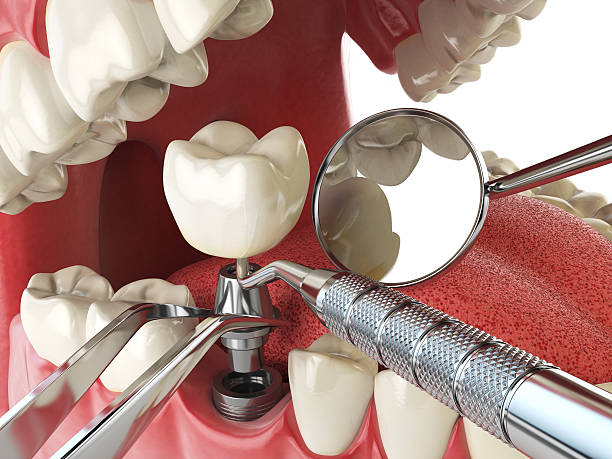 Best Emergency Dental Care for Broken or Chipped Teeth in Ferrum, VA